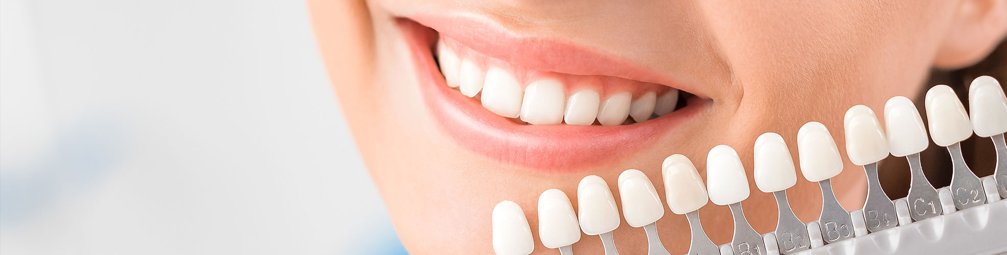veeners dentali