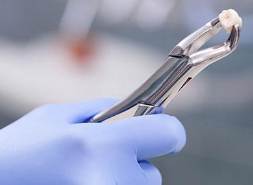 estrazione del dente