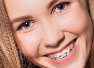 ragazza con apparecchio per denti
